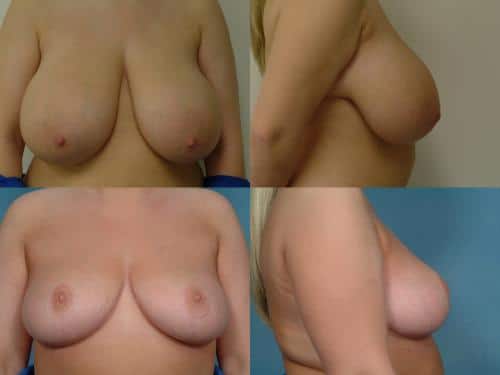 Breast Reduction Case #184 Combined Image