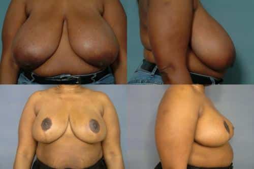 Breast Reduction Case #186 Combined Image