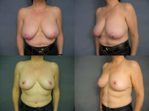 Breast Reduction Case #187 Combined Image