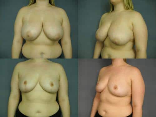 Breast Reduction Case #201 Combined Image