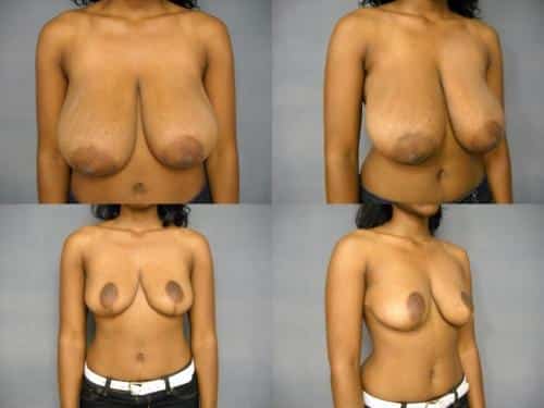 Breast Reduction Case #202 Combined Image
