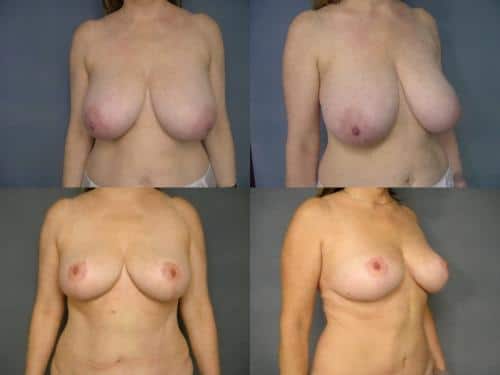 Breast Reduction Case #203 Combined Image