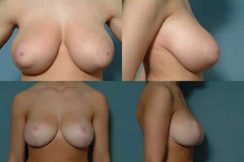 Breast Reduction Case #215 Combined Image