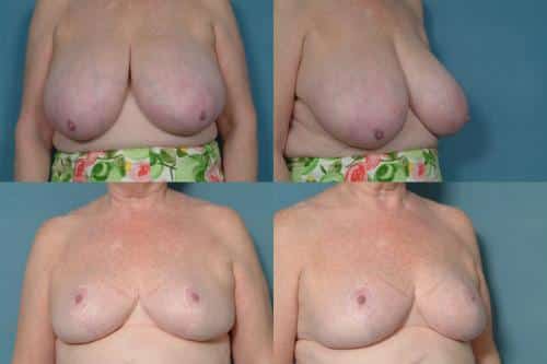 Breast Reduction Case #216 Combined Image