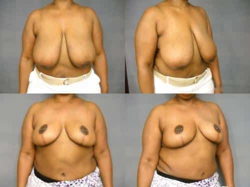 Breast Reduction Case #233 Combined Image