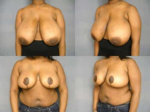 Breast Reduction Case #241 Combined Image