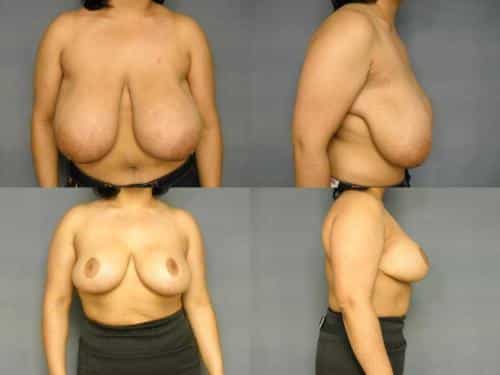 Breast Reduction Case #261 Combined Image