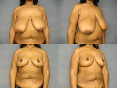 Breast Reduction Case #266 Combined Image
