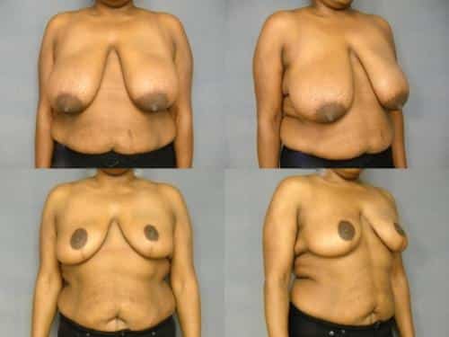 Breast Reduction Case #267 Combined Image