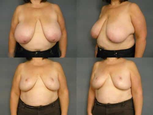 Breast Reduction Case #268 Combined Image