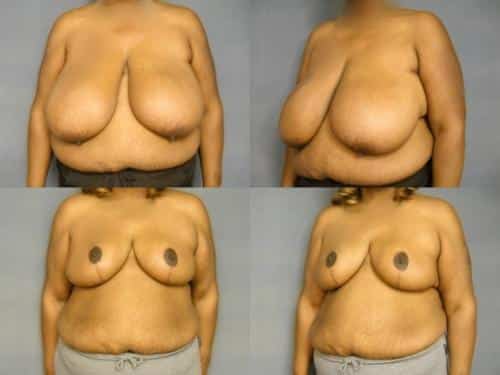 Breast Reduction Case #269 Combined Image
