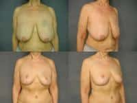 Breast Reduction Case #270 Combined Image