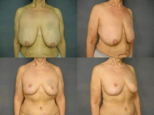 Breast Reduction Case #270 Combined Image