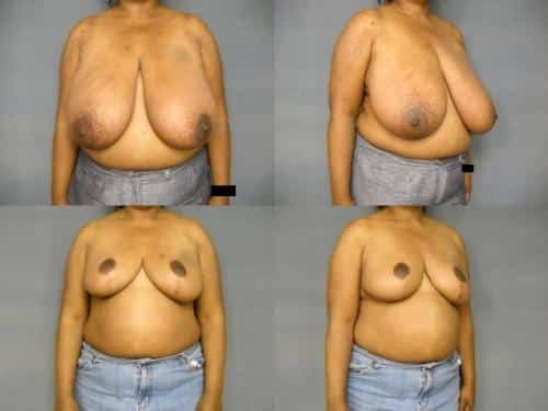 Breast Reduction Case #274 Combined Image