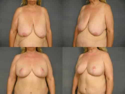 Breast Reduction Case #290 Combined Image
