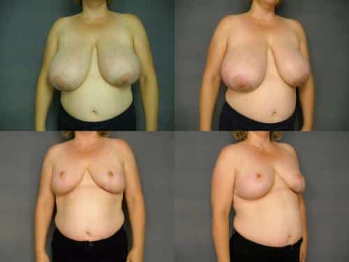 Breast Reduction Case #291 Combined Image