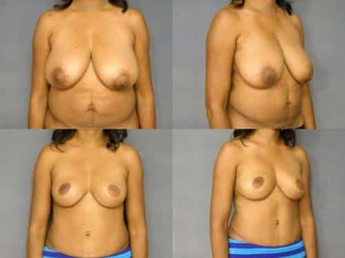 Breast Reduction Case #297 Combined Image