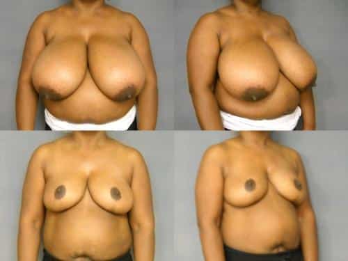 Breast Reduction Case #306 Combined Image