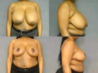 Breast Reduction Case #308 Combined Image