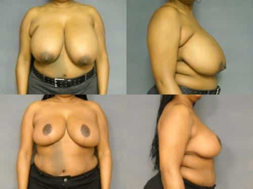 Breast Reduction Case #308 Combined Image