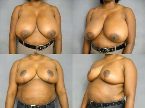 Breast Reduction Case #531 Combined Image