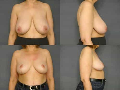 Breast Reduction Case #541 Combined Image