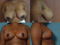 Breast Reduction Case #551 Combined Image