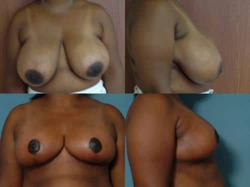 Breast Reduction Case #551 Combined Image