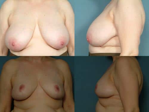 Breast Reduction Case #581 Combined Image
