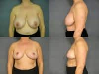Breast Reduction Case #591 Combined Image