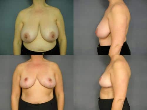 Breast Reduction Case #591 Combined Image