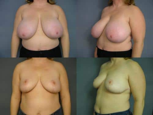 Breast Reduction Case #631 Combined Image