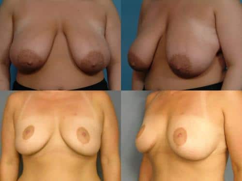 Breast Reduction Case #671 Combined Image