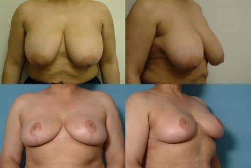 Breast Reduction Case #741 Combined Image