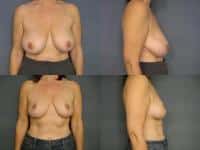 Breast Reduction Case #751 Combined Image