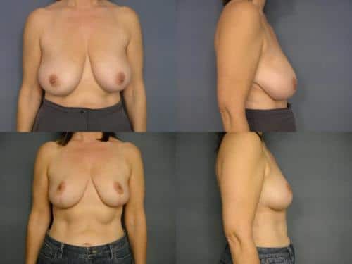 Breast Reduction Case #751 Combined Image