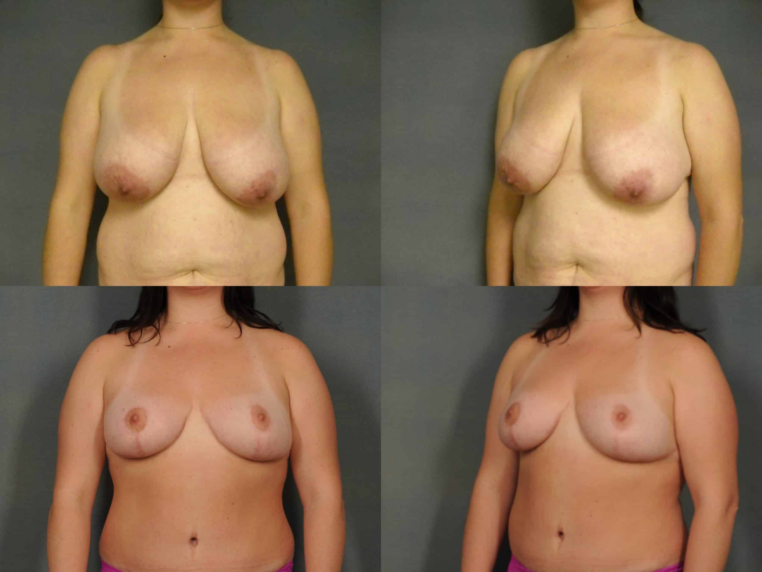 Breast Reduction Case# 776 Combined Image