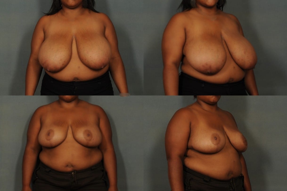 Breast Reduction Case# 801 Combined Image