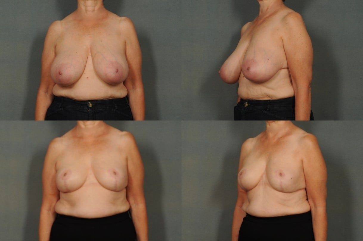 Breast Reduction Case# 803 Combined Image