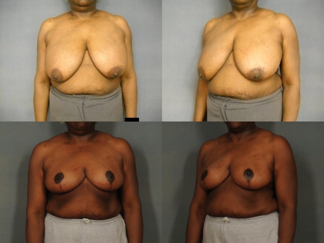 Breast Reduction Case# 808 Combined Image