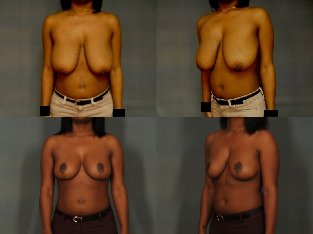 Breast Reduction Case# 812 Combined Image