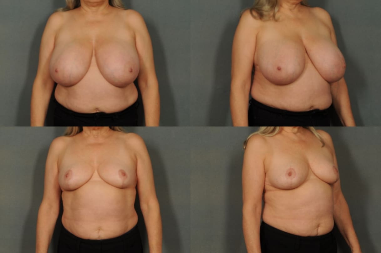 Breast Reduction Case# 817 Combined Image