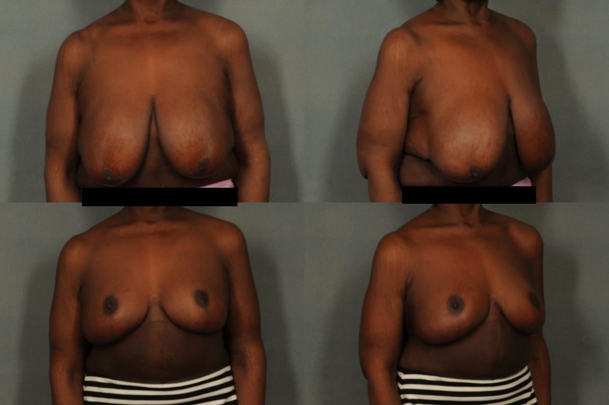 Breast Reduction Case# 822 Combined Image
