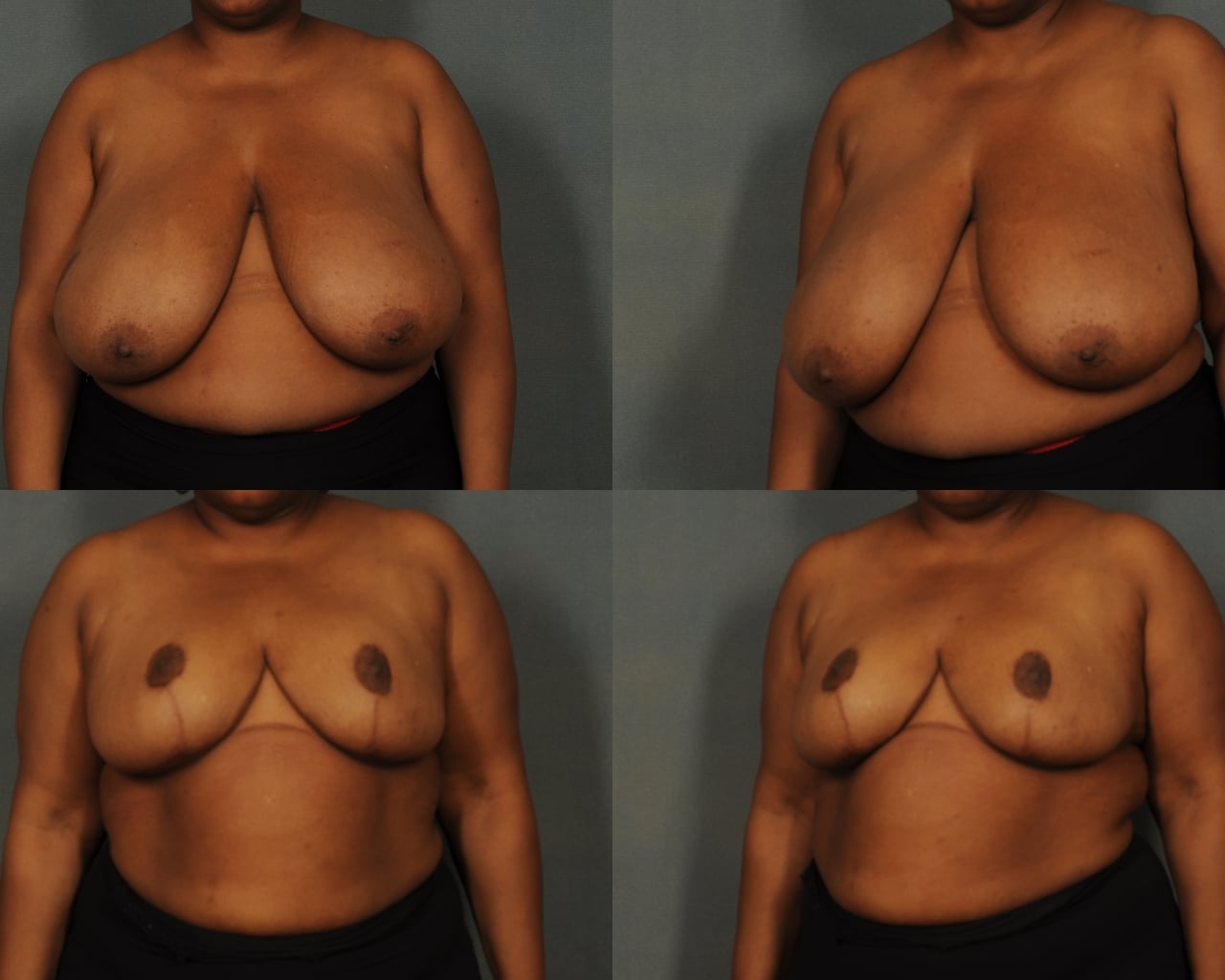 Breast Reduction Case# 827 Combined Image