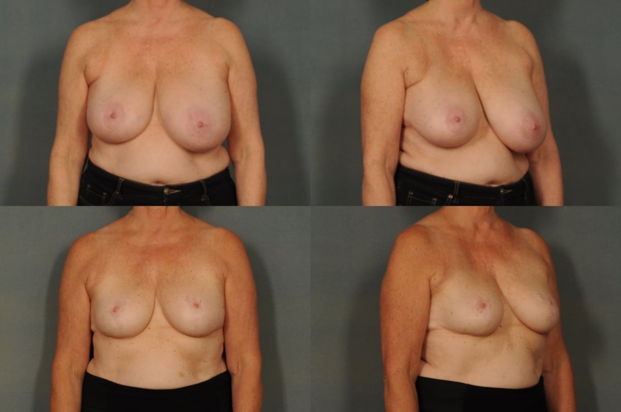 Breast Reduction Case# 828 Combined Image