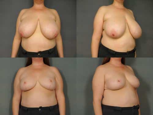 Breast Reduction Case #831 Combined Image