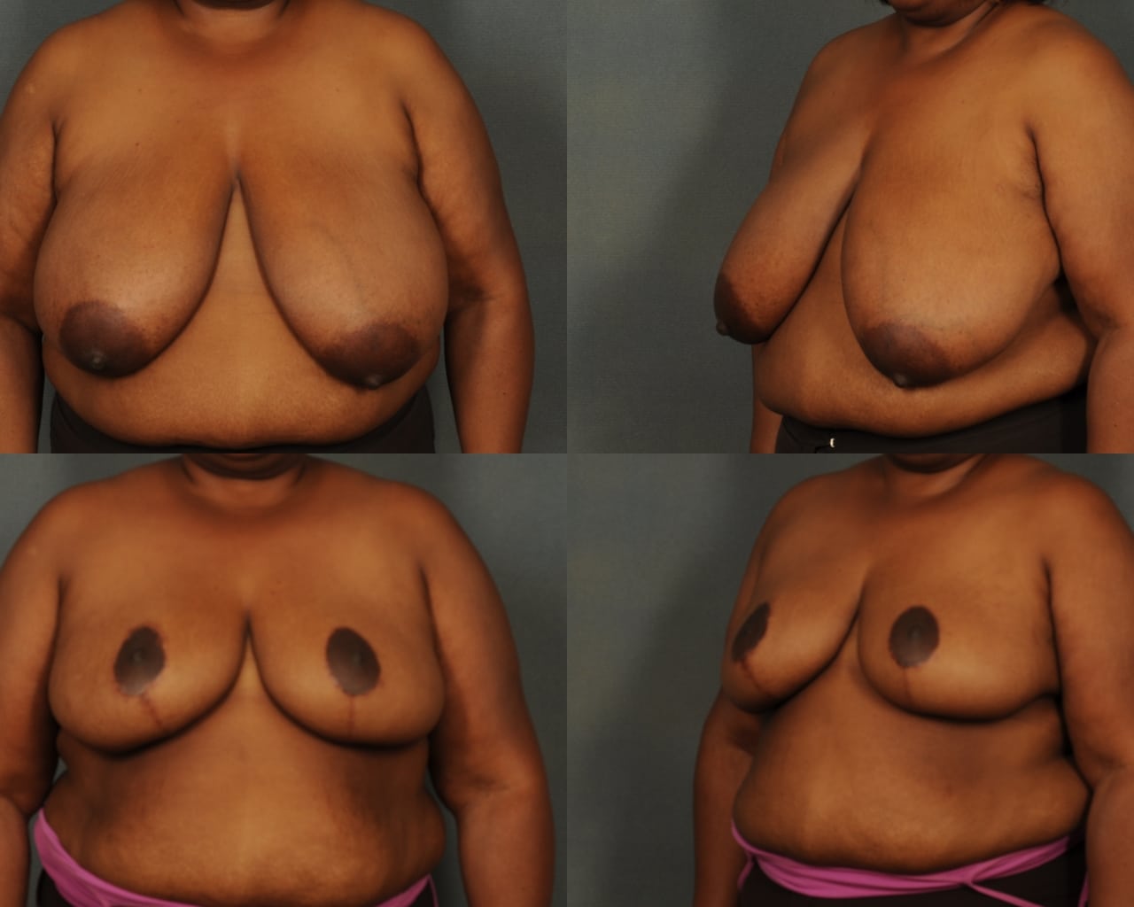 Breast Reduction Case# 835 Combined Image