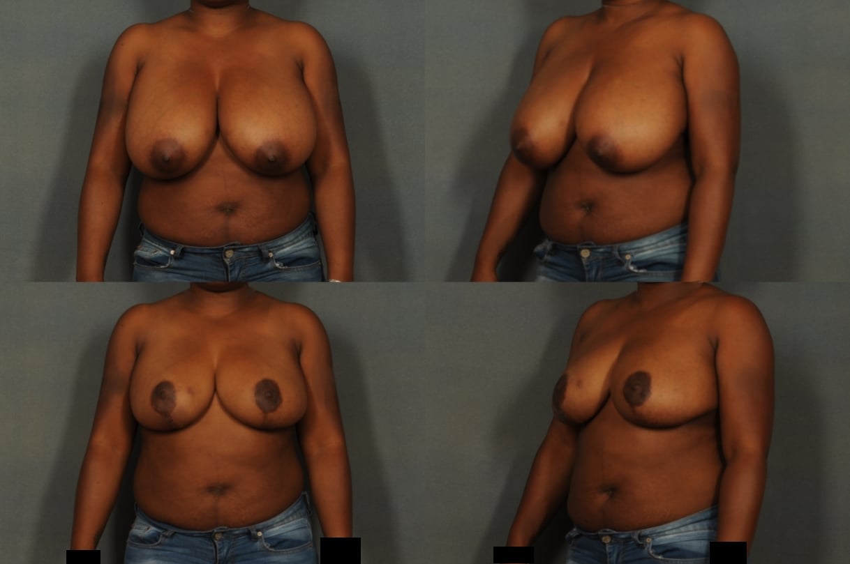 Breast Reduction Case# 836 Combined Image