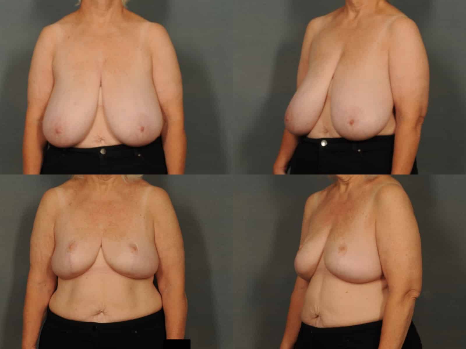 Breast Reduction Case# 849 Combined Image