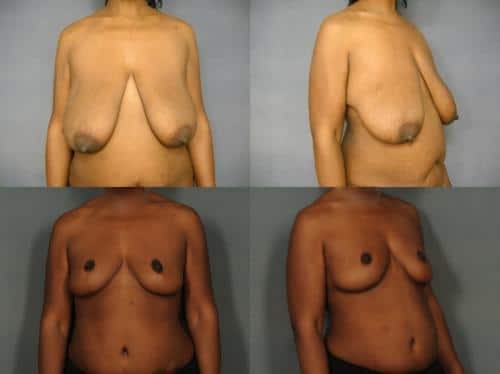 Breast Reduction Case #851 Combined Image